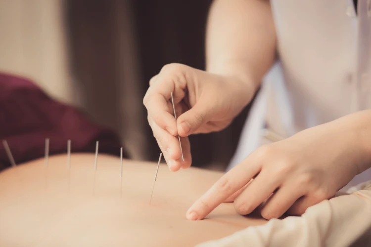 L'agopuntura: un valido contributo sulla fertilità